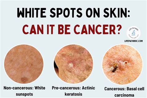 white melanoma spots pictures